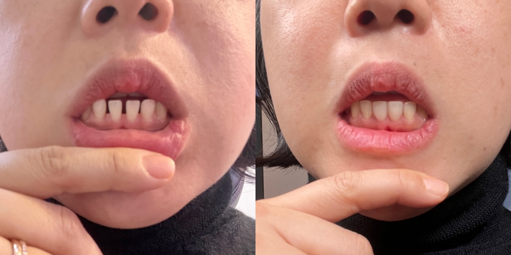 2D 치과 블랙필름 라미네이트 비포 애프터